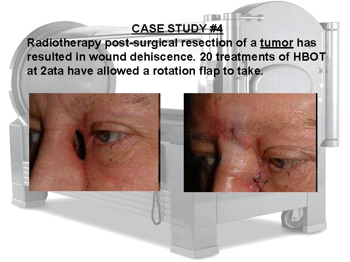CASE STUDY #4 Radiotherapy post-surgical resection of a tumor has resulted in wound dehiscence.
