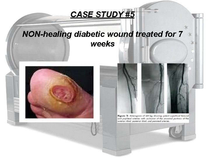 CASE STUDY #5 NON-healing diabetic wound treated for 7 weeks 