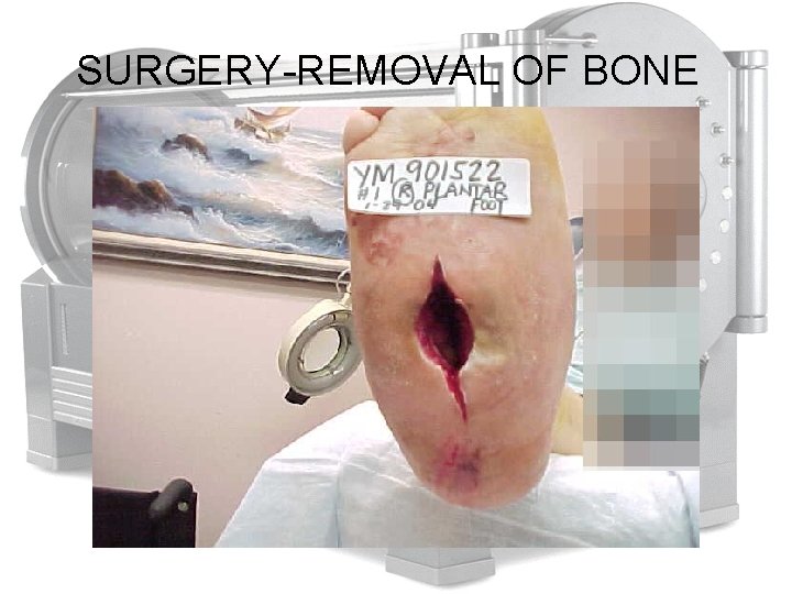 SURGERY-REMOVAL OF BONE 
