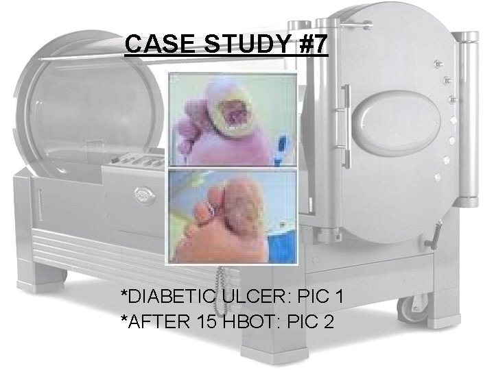 CASE STUDY #7 *DIABETIC ULCER: PIC 1 *AFTER 15 HBOT: PIC 2 