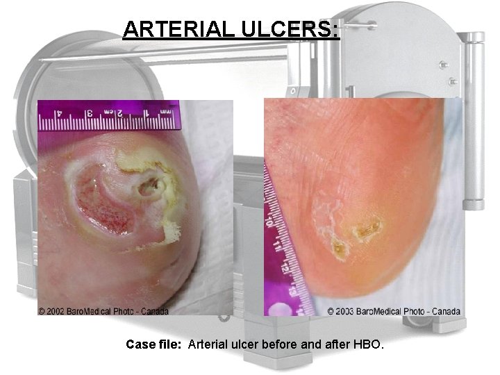 ARTERIAL ULCERS: Case file: Arterial ulcer before and after HBO. 
