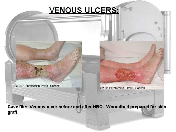 VENOUS ULCERS: Case file: Venous ulcer before and after HBO. Woundbed prepared for skin