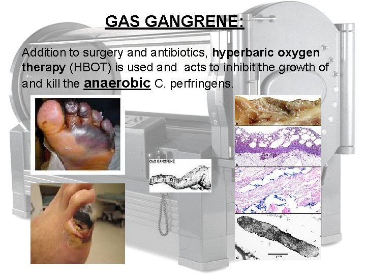 GAS GANGRENE: Addition to surgery and antibiotics, hyperbaric oxygen therapy (HBOT) is used and