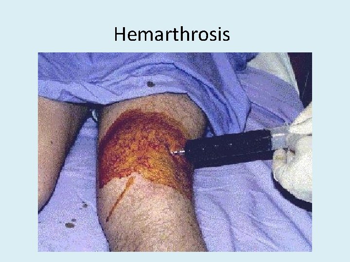 Hemarthrosis 