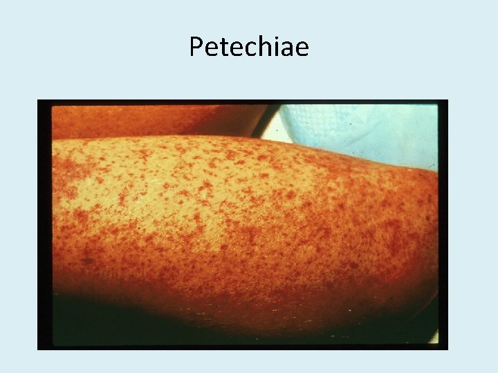 Petechiae 