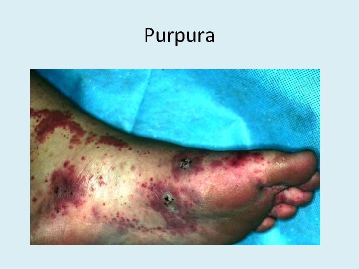 Purpura 