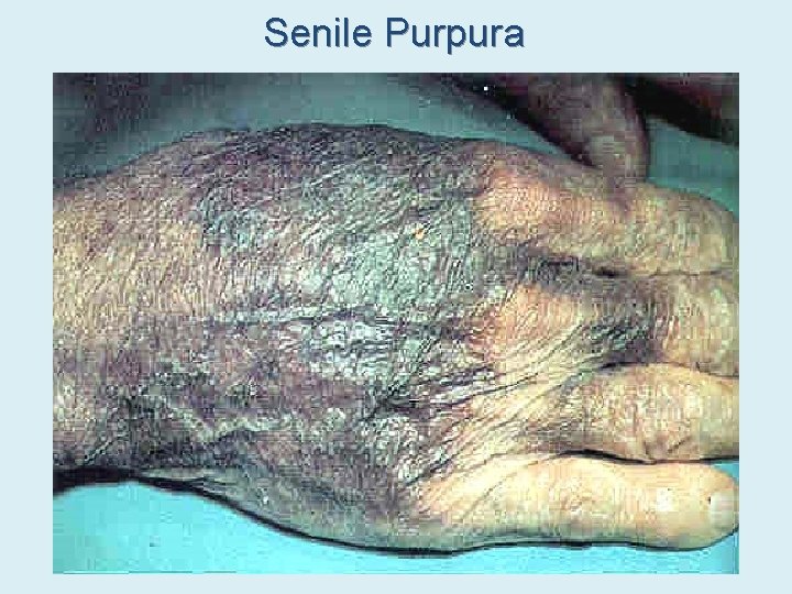 Senile Purpura 