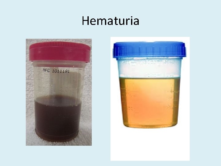 Hematuria 