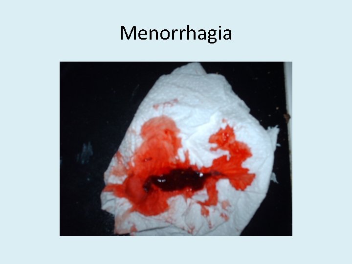 Menorrhagia 