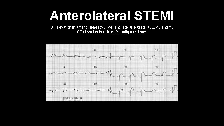 Anterolateral STEMI ST elevation in anterior leads (V 3, V 4) and lateral leads