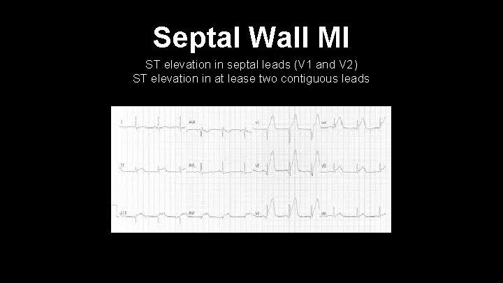 Septal Wall MI ST elevation in septal leads (V 1 and V 2) ST