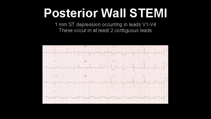 Posterior Wall STEMI 1 mm ST depression occurring in leads V 1 -V 4