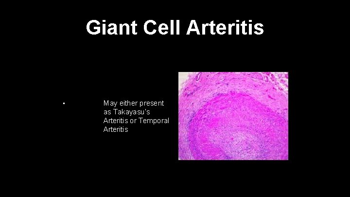 Giant Cell Arteritis • May either present as Takayasu’s Arteritis or Temporal Arteritis 