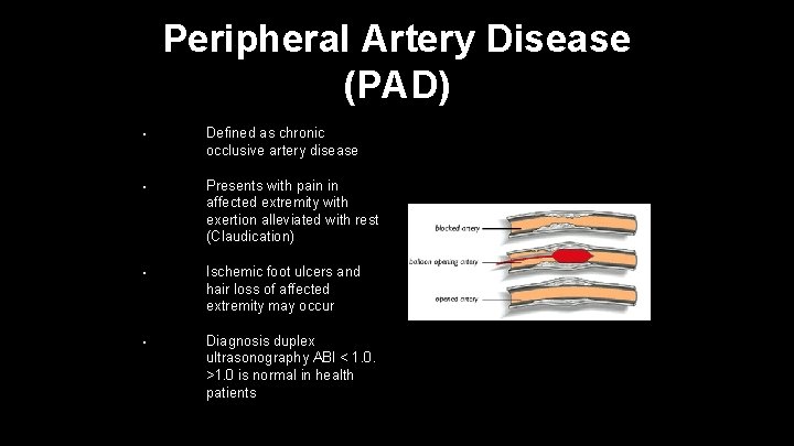 Peripheral Artery Disease (PAD) • Defined as chronic occlusive artery disease • Presents with