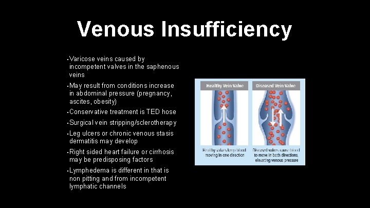 Venous Insufficiency • Varicose veins caused by incompetent valves in the saphenous veins •