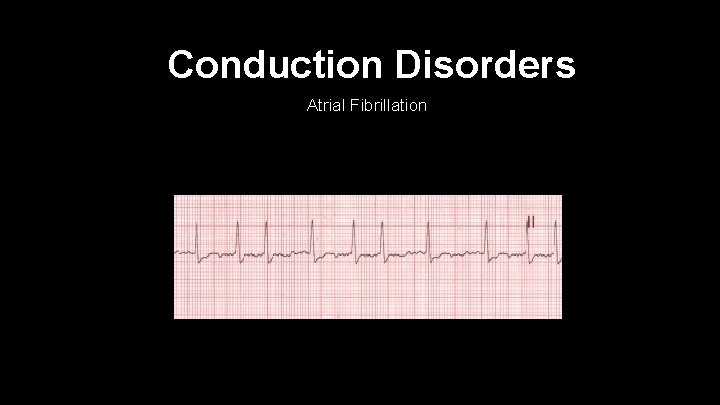 Conduction Disorders Atrial Fibrillation 