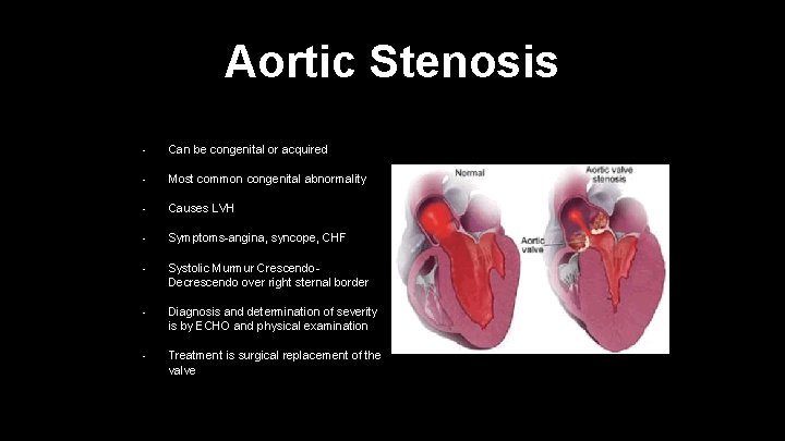 Aortic Stenosis • Can be congenital or acquired • Most common congenital abnormality •