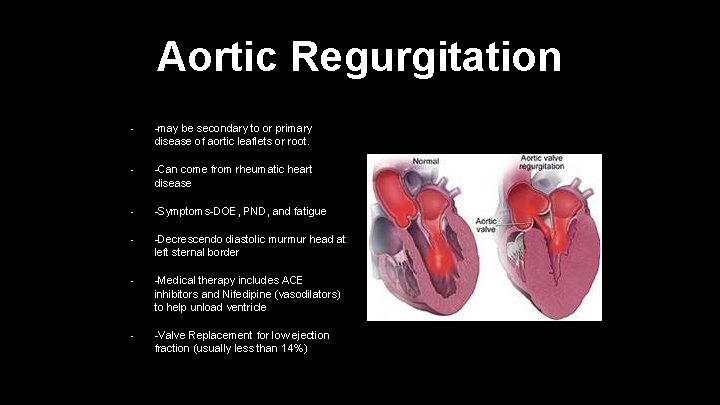 Aortic Regurgitation • -may be secondary to or primary disease of aortic leaflets or