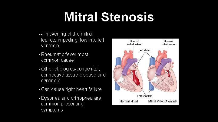 Mitral Stenosis • -Thickening of the mitral leaflets impeding flow into left ventricle •