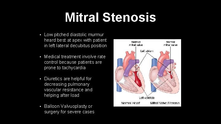 Mitral Stenosis • Low pitched diastolic murmur heard best at apex with patient in