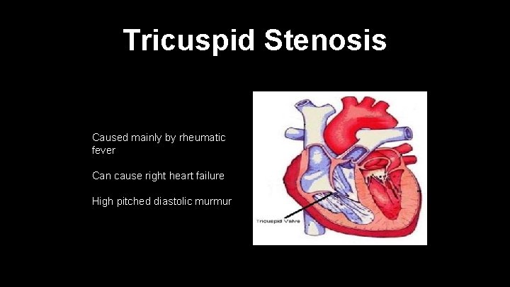 Tricuspid Stenosis Caused mainly by rheumatic fever Can cause right heart failure High pitched