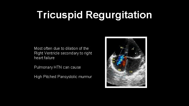 Tricuspid Regurgitation Most often due to dilation of the Right Ventricle secondary to right