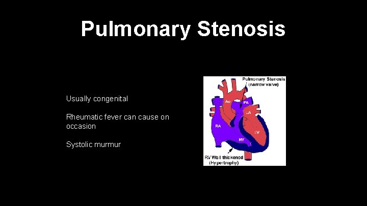 Pulmonary Stenosis Usually congenital Rheumatic fever can cause on occasion Systolic murmur 
