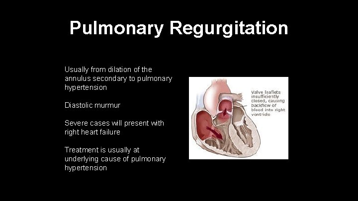 Pulmonary Regurgitation Usually from dilation of the annulus secondary to pulmonary hypertension Diastolic murmur