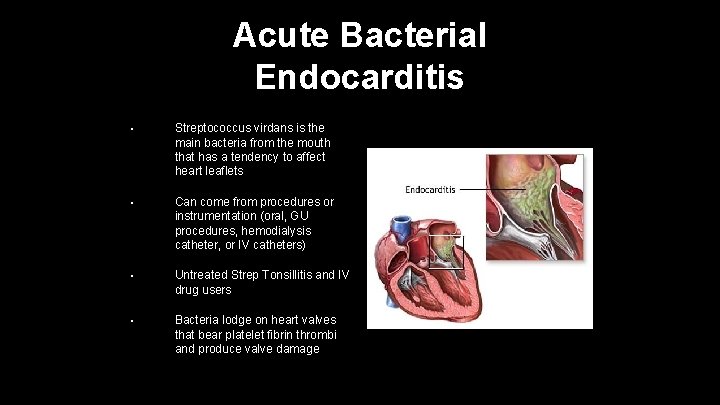 Acute Bacterial Endocarditis • Streptococcus virdans is the main bacteria from the mouth that