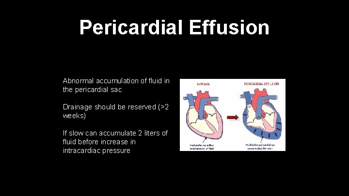 Pericardial Effusion Abnormal accumulation of fluid in the pericardial sac Drainage should be reserved