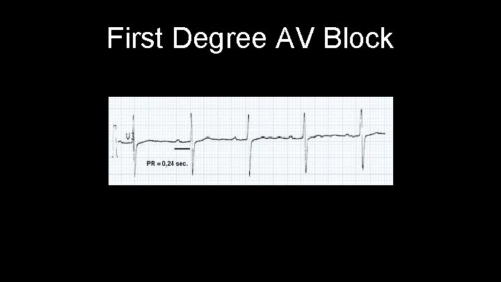 First Degree AV Block 