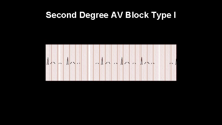 Second Degree AV Block Type I 