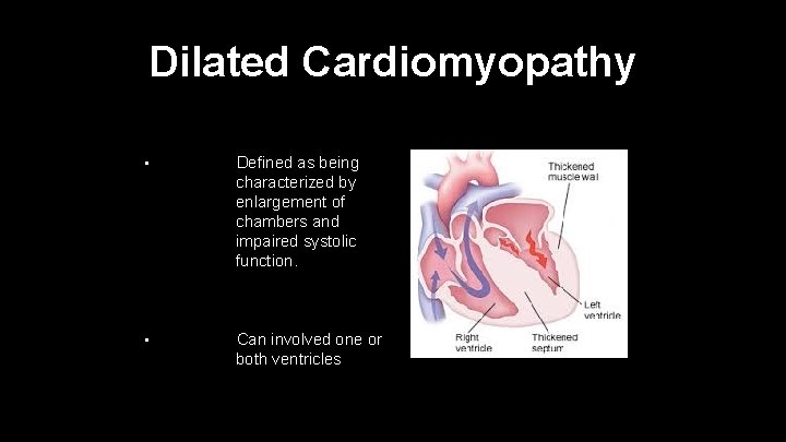 Dilated Cardiomyopathy • Defined as being characterized by enlargement of chambers and impaired systolic