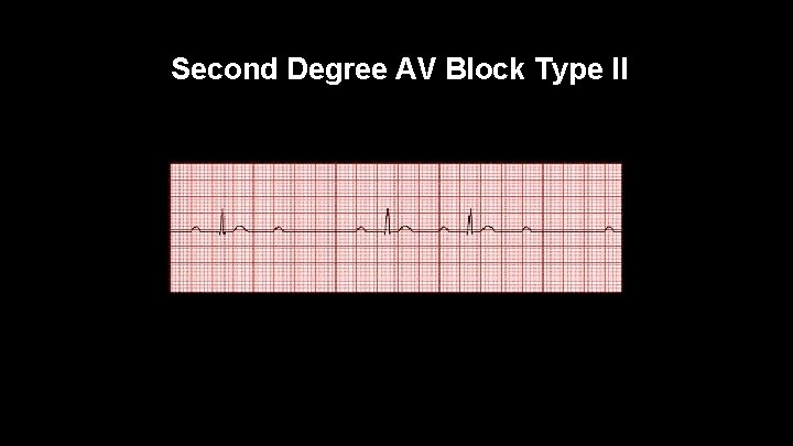 Second Degree AV Block Type II 