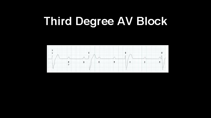 Third Degree AV Block 