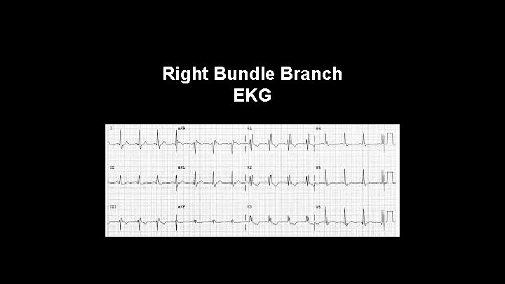 Right Bundle Branch EKG 