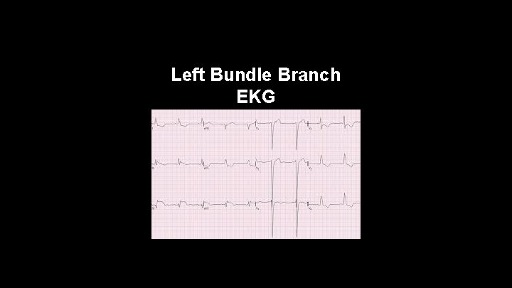 Left Bundle Branch EKG 