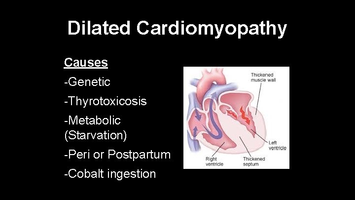 Dilated Cardiomyopathy Causes -Genetic -Thyrotoxicosis -Metabolic (Starvation) -Peri or Postpartum -Cobalt ingestion 