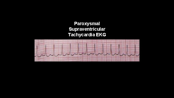 Paroxysmal Supraventricular Tachycardia EKG 