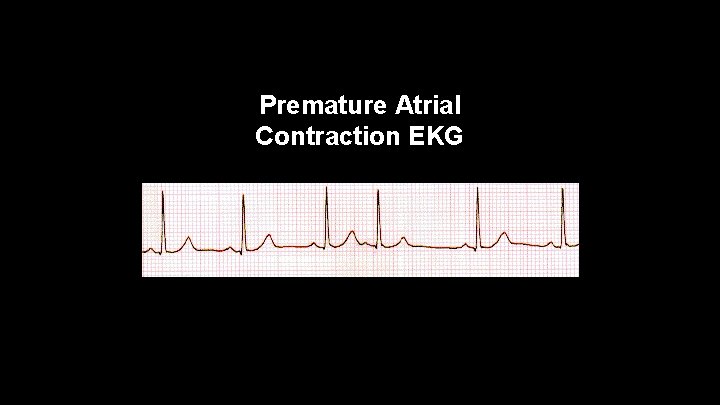 Premature Atrial Contraction EKG 