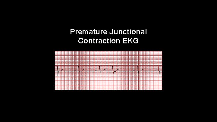 Premature Junctional Contraction EKG 