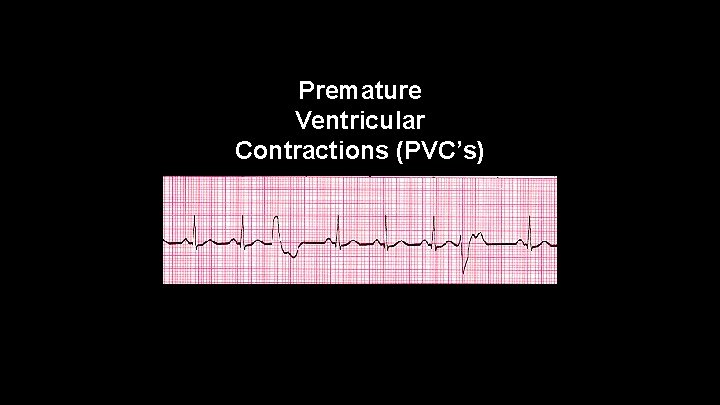 Premature Ventricular Contractions (PVC’s) 