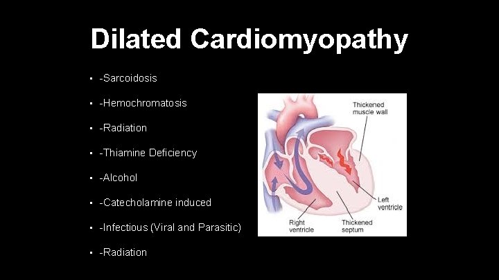 Dilated Cardiomyopathy • -Sarcoidosis • -Hemochromatosis • -Radiation • -Thiamine Deficiency • -Alcohol •