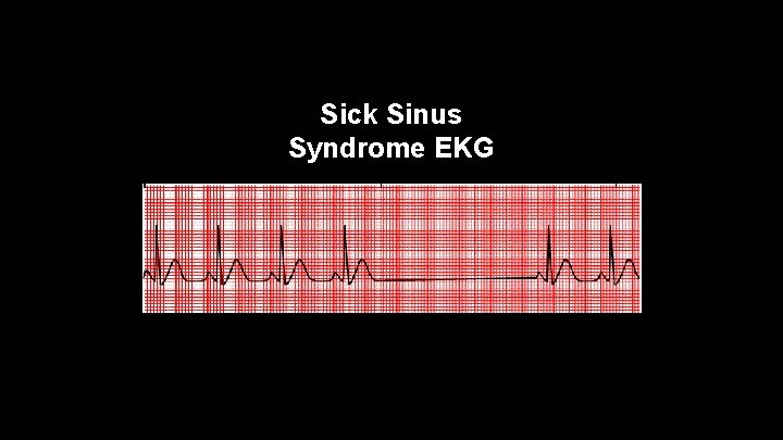 Sick Sinus Syndrome EKG 