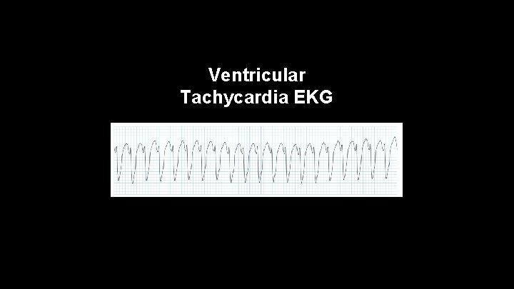 Ventricular Tachycardia EKG 