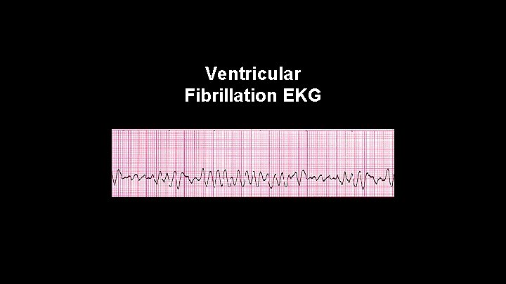 Ventricular Fibrillation EKG 