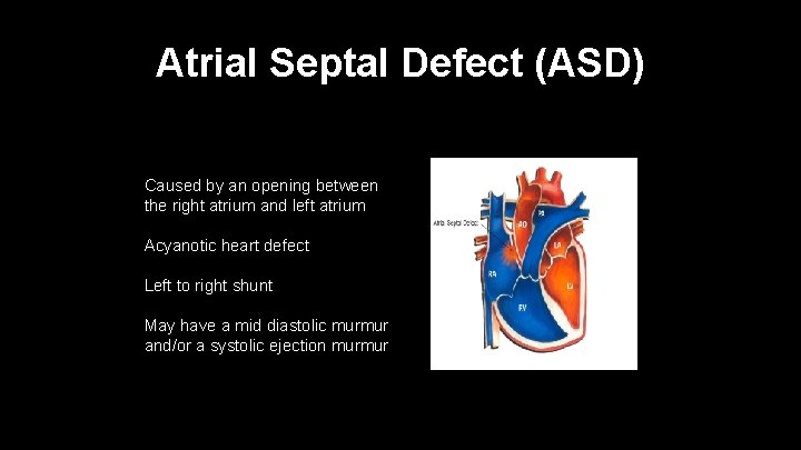 Atrial Septal Defect (ASD) Caused by an opening between the right atrium and left