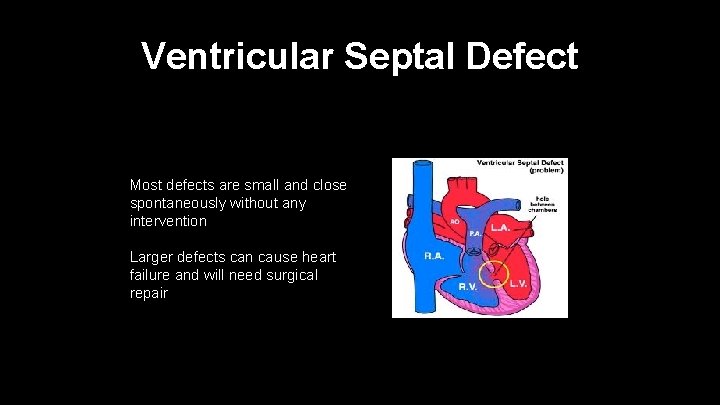 Ventricular Septal Defect Most defects are small and close spontaneously without any intervention Larger