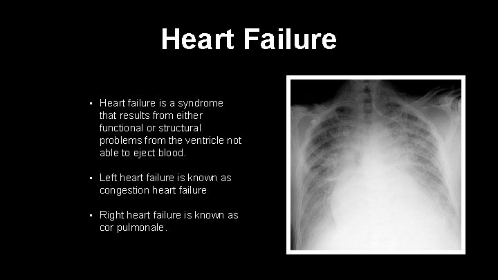 Heart Failure • Heart failure is a syndrome that results from either functional or