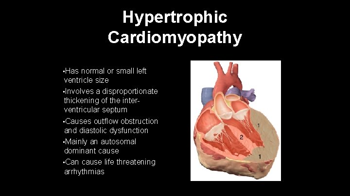 Hypertrophic Cardiomyopathy • Has normal or small left ventricle size • Involves a disproportionate